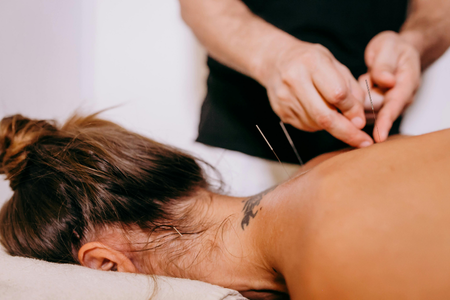 Physical therapist applying dry needles to patient's neck and shoulder